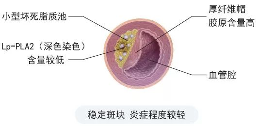 【20240425期】心脑血管疾病的“报警器”——脂蛋白相关磷脂酶A2（LP-PLA2）(图2)