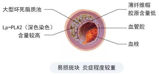 【20240425期】心脑血管疾病的“报警器”——脂蛋白相关磷脂酶A2（LP-PLA2）